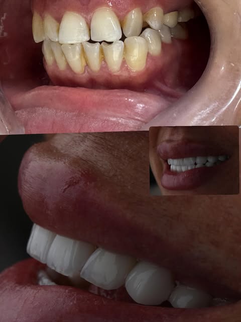 ابتسامة هوليوود · قشور خزفية